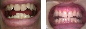 crooked front teeth before and after braces