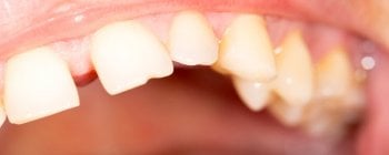diastema teeth gap