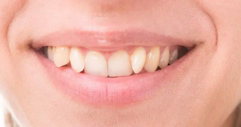 teeth straightening uk