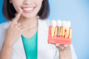 Dental implants treatment