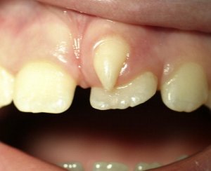 Extra teeth growing in gums