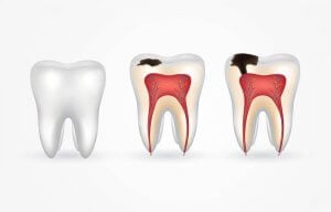 prevent tooth pulpitis
