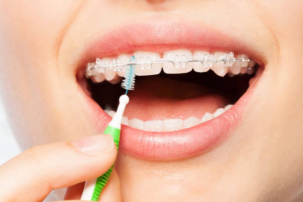 dental cleaning with braces