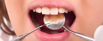 tartar plaque teeth