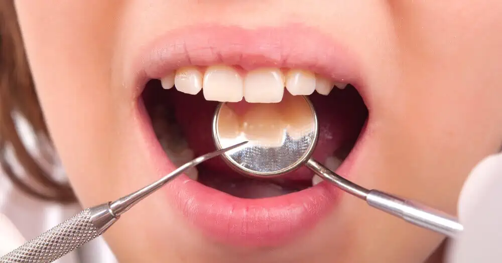 Dental Plaque vs Tartar and Removing It From Teeth