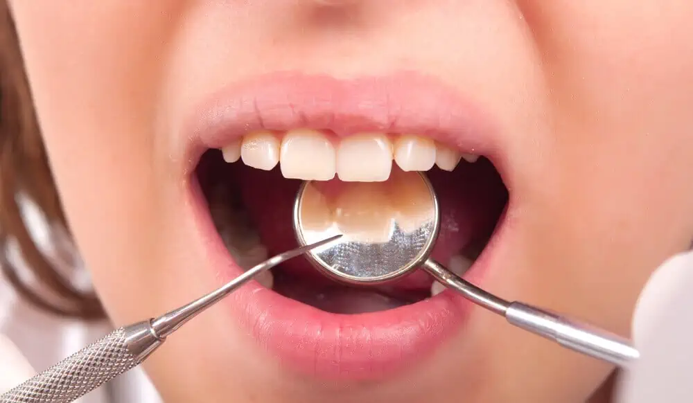 Dental Plaque vs Tartar and Removing It From Teeth