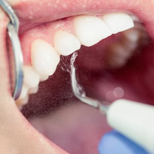 teeth more sensitive after cleaning