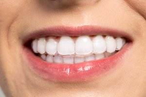 ClearCorrect vs Invisalign