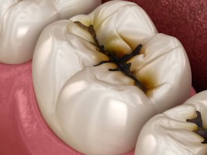 pits and fissures in tooth