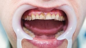 patient with severe fluorosis