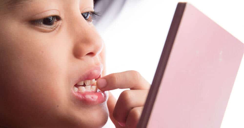 dental fluorosis in children