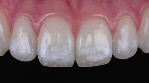 Fluorosis levels