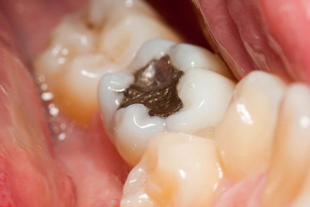 teeth fillings for cavities