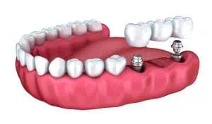 dental restoration