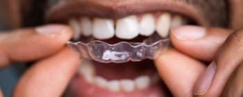 man using invisible braces like invisalign