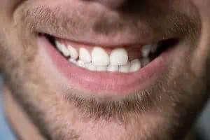 restore missing teeth