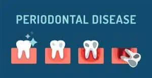 receding gums causes