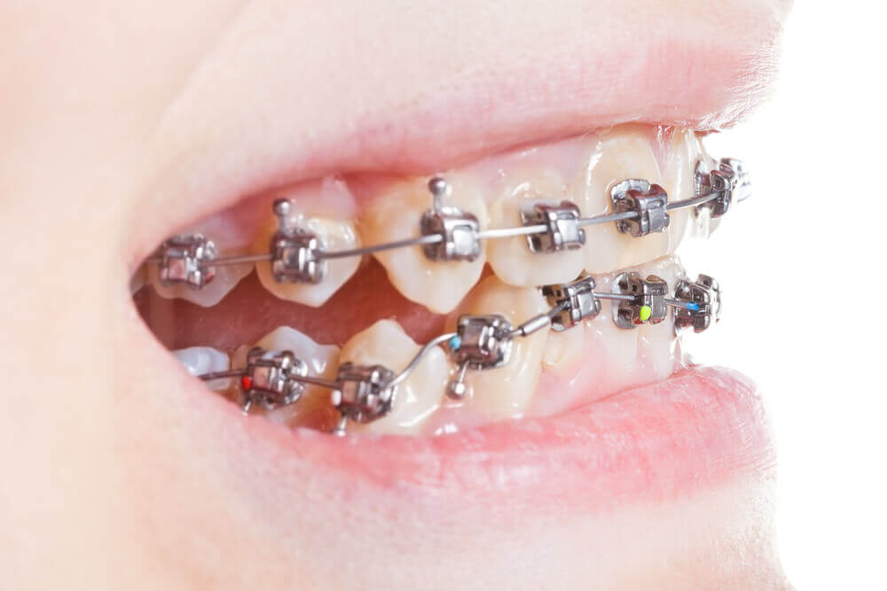 white spots on childrens teeth