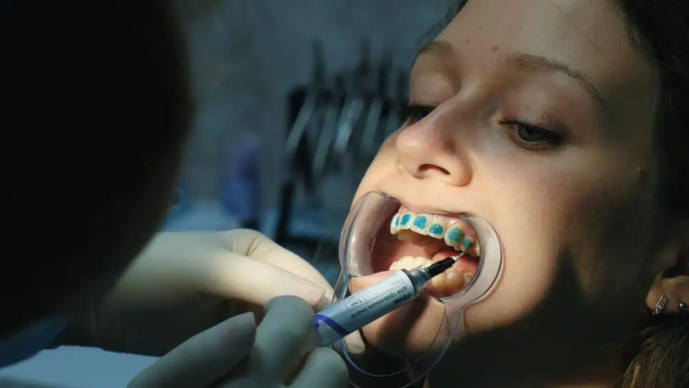 Blue dental glue is being applied