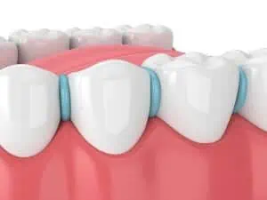 rubber dental spacers