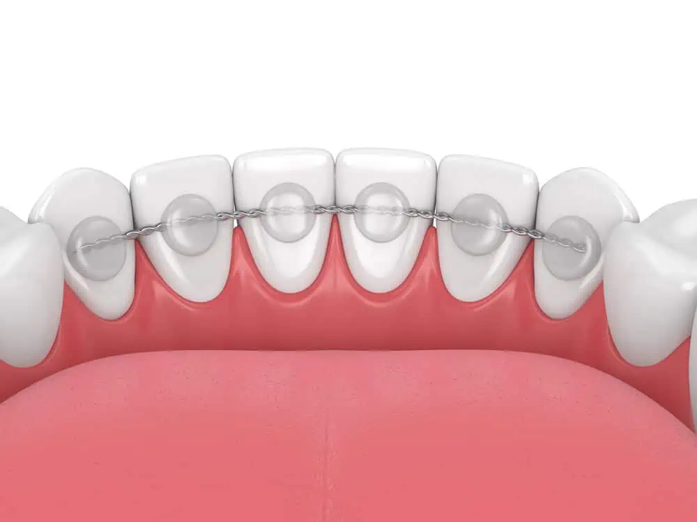 Hawley Retainer Costs, Advantages and Disadvantages