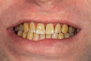 Yellow stained teeth from smoking