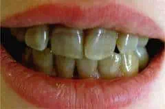 Tetracycline Teeth