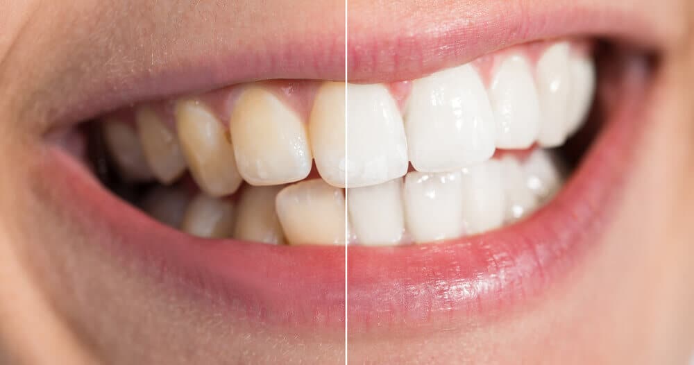 Real Snow Teeth Whitening Reviews Does This System Work?