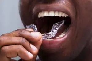 inman aligner costs