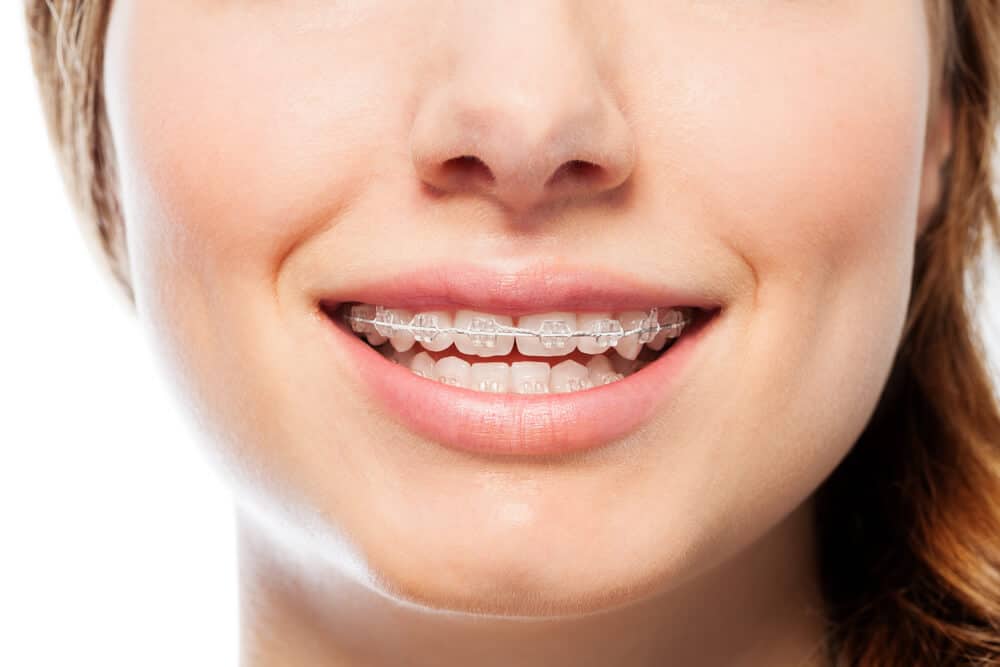 White Braces Different Types and Pros and Cons, and Photos