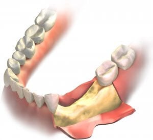 Bone loss from gum disease