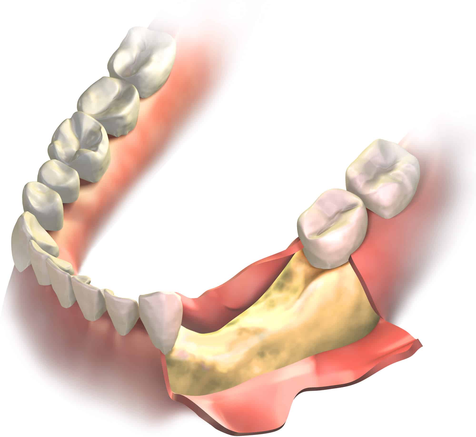 Bone Graft Before Dental Implants Cost and Procedure