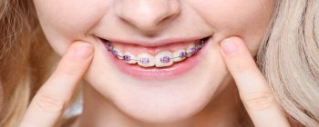 How and Why DIY Braces are Dangerous