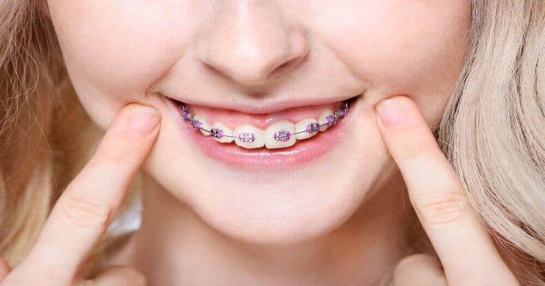 fake braces fake braces