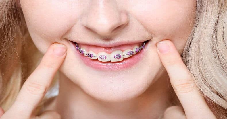 Fake Braces What Are They And Why Are They Popular 