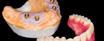 snap-in dentures