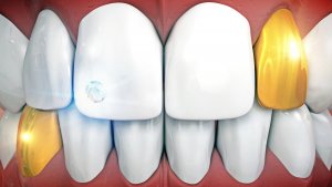 anterior implants with gold teeth implants