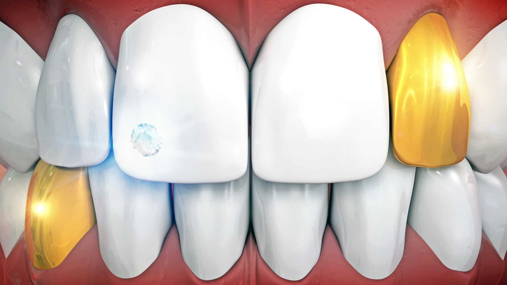 Permanent Gold Teeth Guide Implants, Crowns, & Grillz