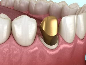 Permanent gold tooth implant