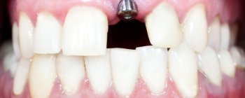 same-day dental implants