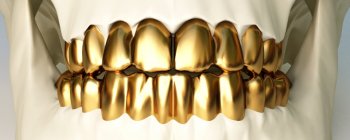 permanent gold teeth implants