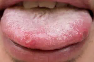 Initial stage of herpes on tongue