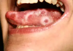 Herpes on Tongue needs quick remedial action to ease discomfort