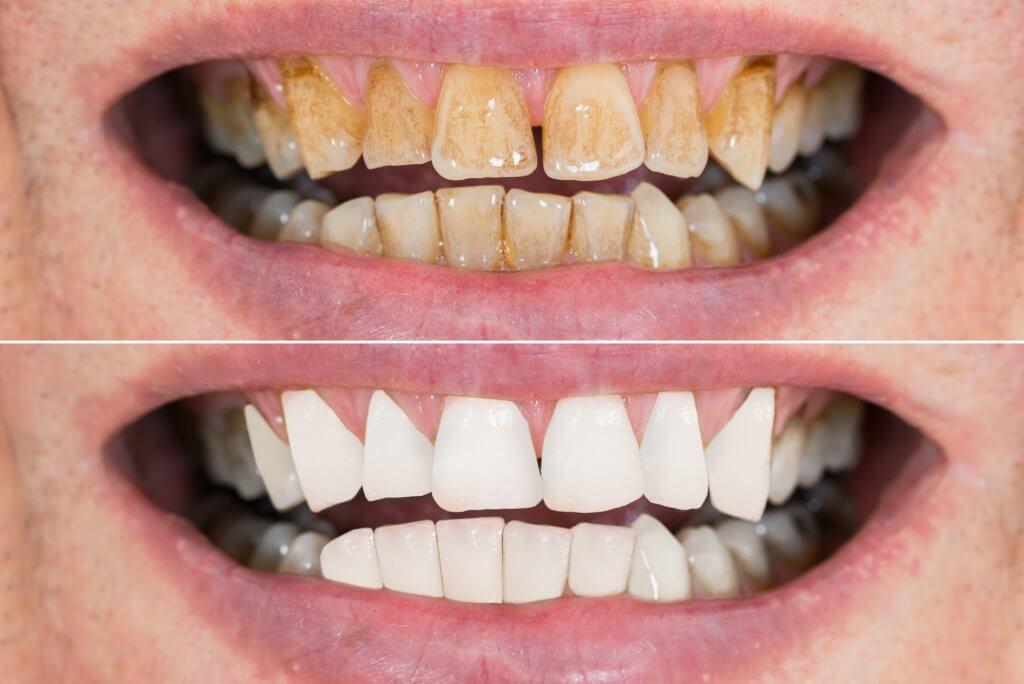 before and after smile makeover
