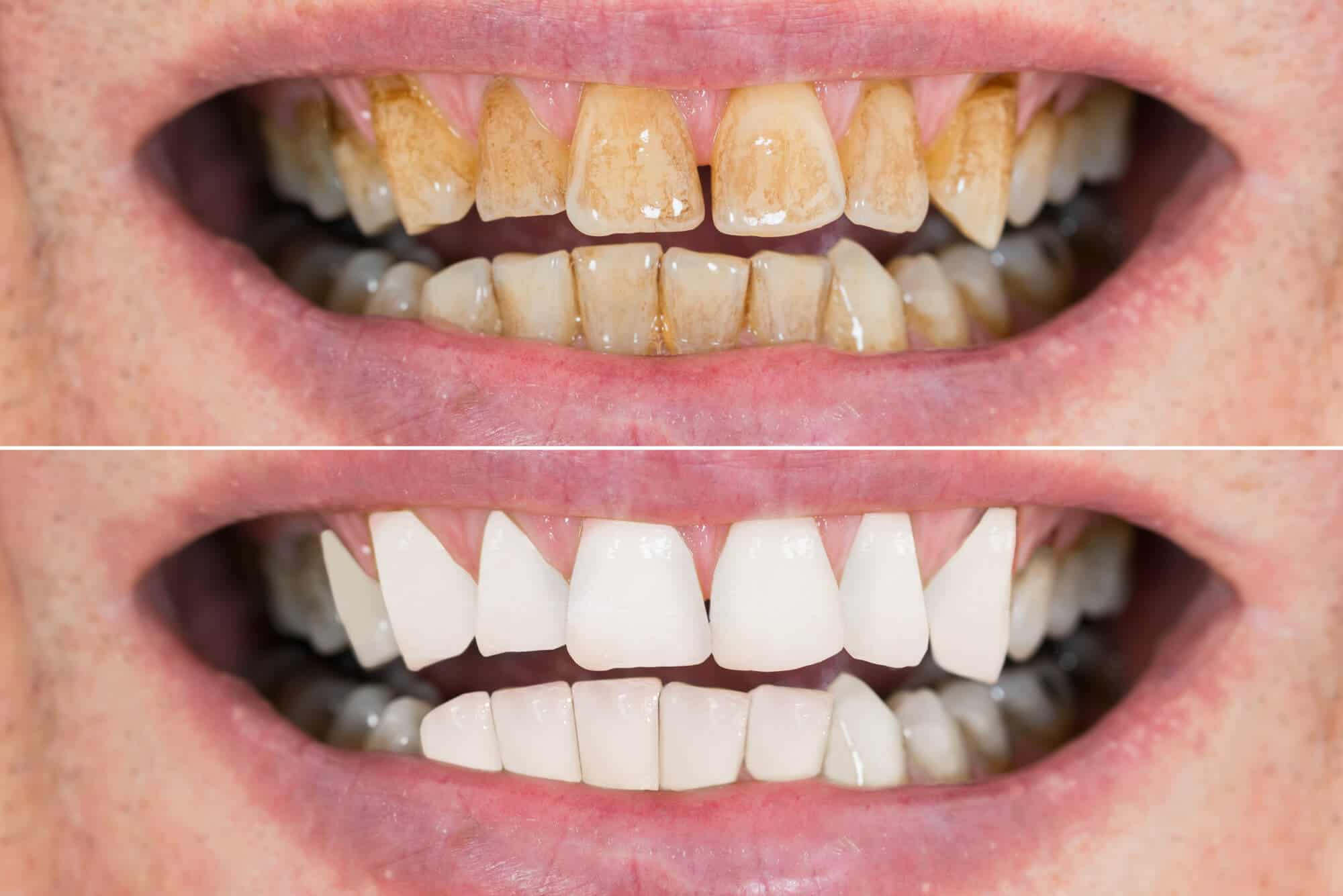 Smile Makeover The Perfect Way to Boost SelfConfidence