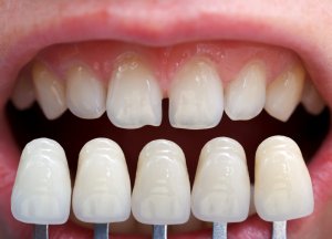 veneers come in several shades