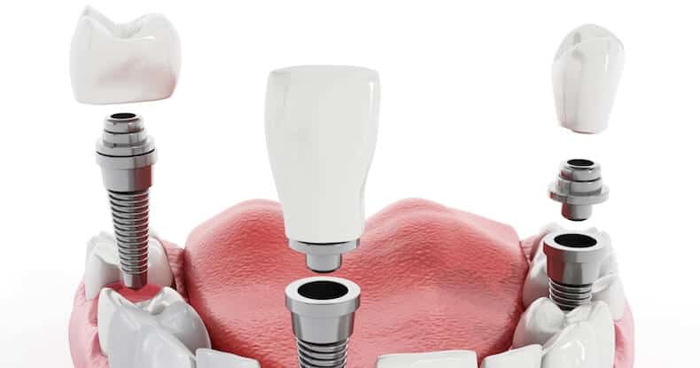 Dental Insurance That Covers Implants: Plans and Prices