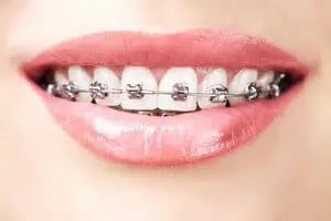 how to apply wax on braces