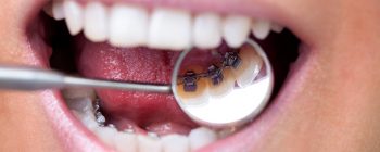 lingual braces