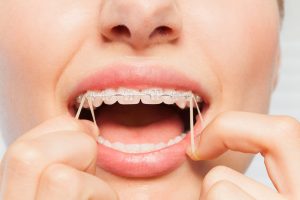 rubber bands for braces pain